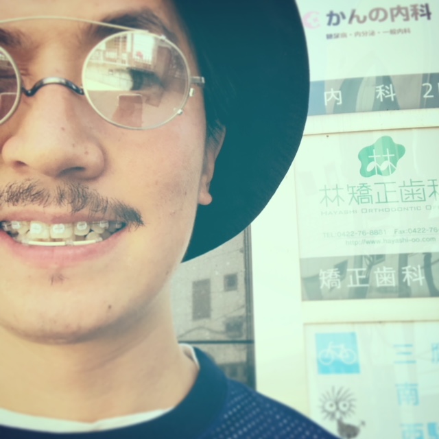 歯科矯正男子 山口祐亮 ４ヶ月経過！！