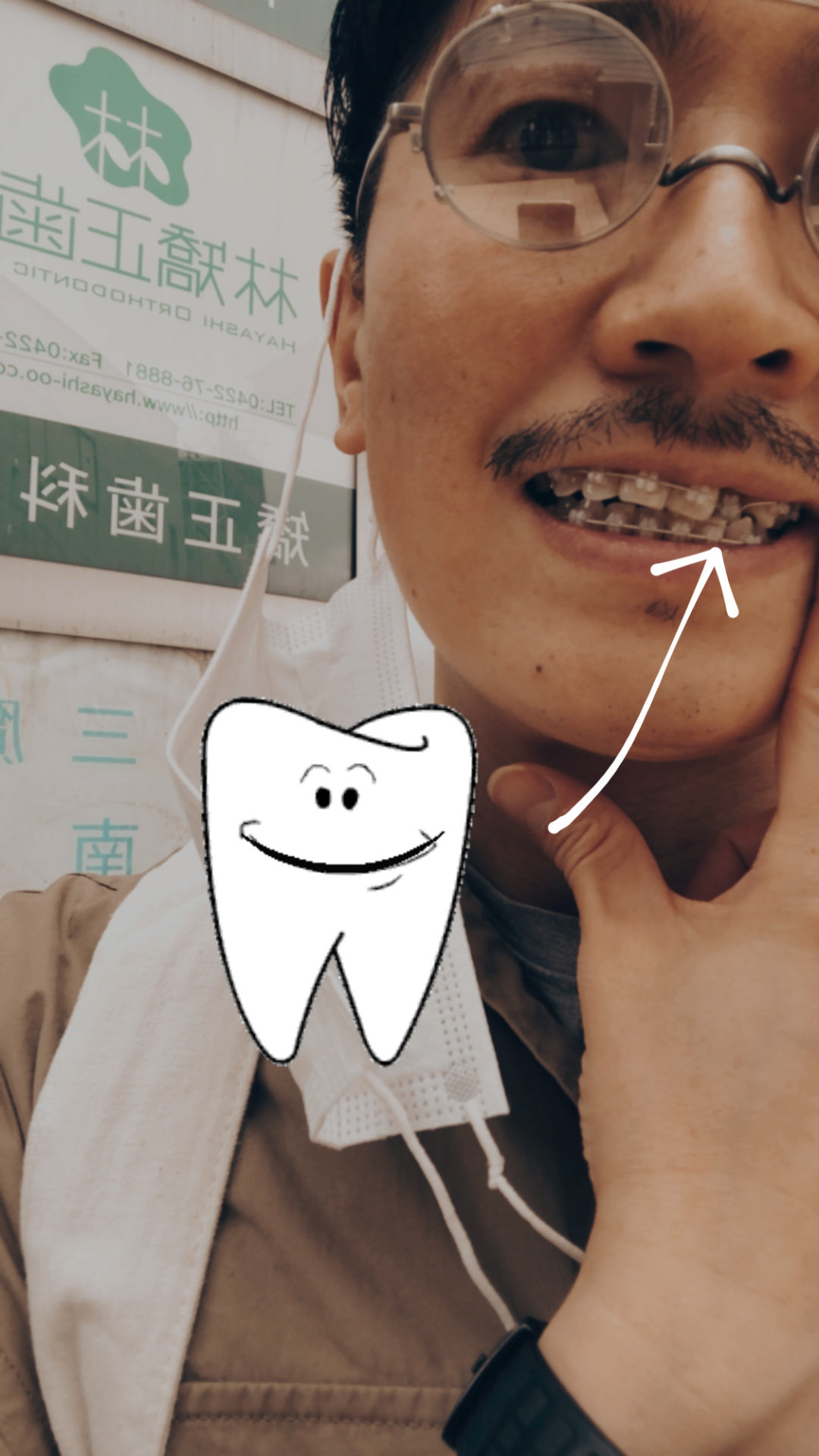 歯科矯正男子 山口祐亮 2年経過いたしました♪