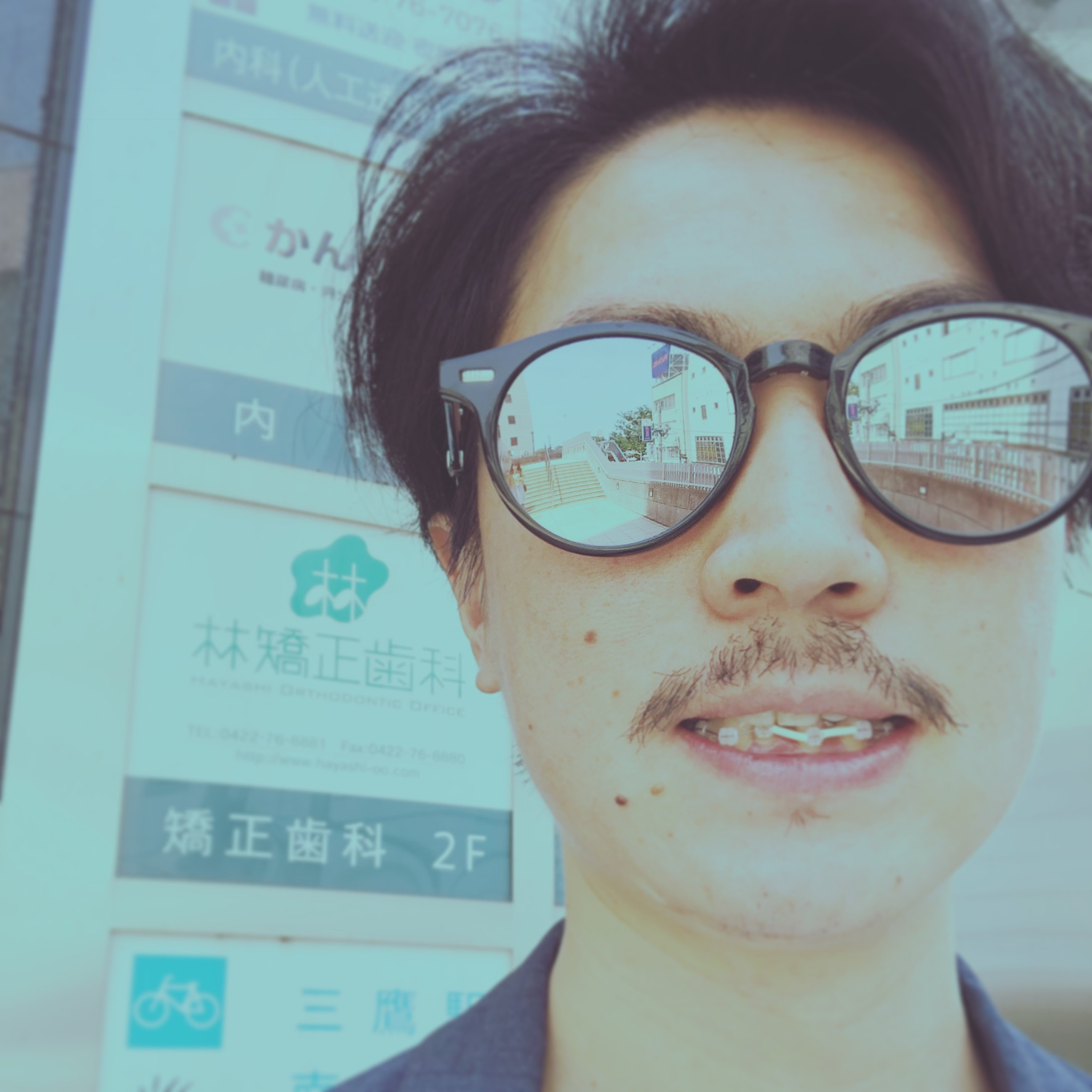 歯科矯正男子ワイヤーからマウスピースへ